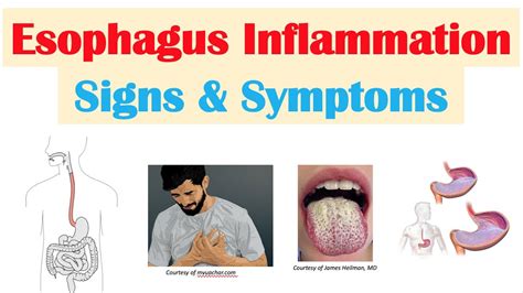 esophagus inflammation symptoms